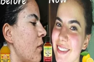Get Rid of Acne Naturally