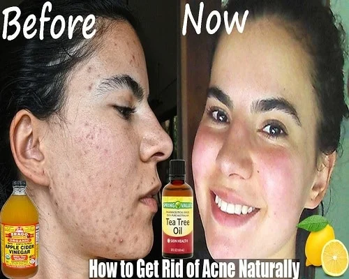 Get Rid of Acne Naturally