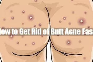 Butt Acne