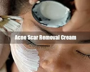 acne scar removal cream