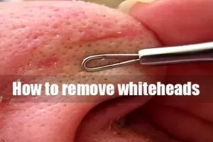 How to remove whiteheads