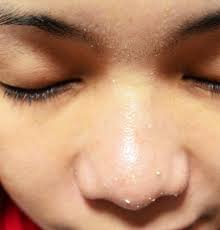Whiteheads on nose removal