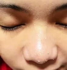 Whiteheads on nose removal
