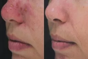 white head acne treatment
