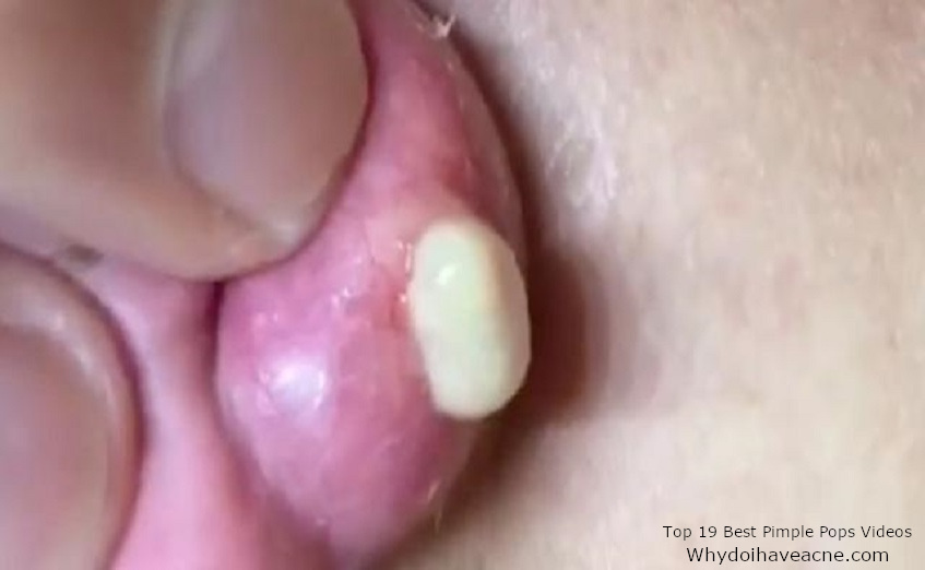 pimple pops videos